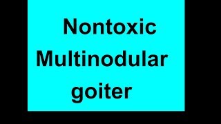 Nontoxic Multinodular goiter [upl. by Sutit731]