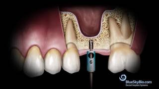 Advanced Simplified Sinus Lift Technique No Probe [upl. by Llehsem]