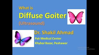 What is Diffuse Goiter Ultrasound features [upl. by Htebazile22]