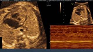 TMT Fetal Echo by Dr Chandrashekhar Kenjale HLHS [upl. by Moynahan]