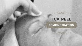 35 TCA peel demonstration [upl. by Emlynn]