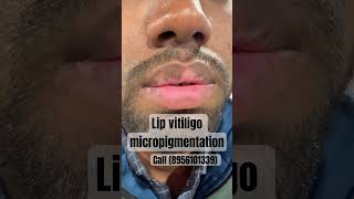 LIP VITILIGO MICROPIGMENTATION  LIP SAFEDDAAG ILAJ LIP COLOURING vitiligo vitiligocures shorts [upl. by Amelus]