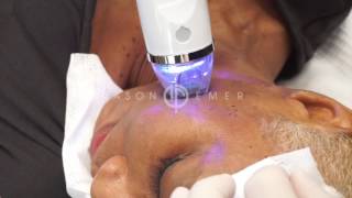 Endymed Intensif RF Micro Needling  Acne Scar Treatment  Pores Treatment  Dr Jason Emer [upl. by Esorbma861]