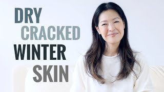 Tips For Treating Dry Cracked Winter Skin  Body [upl. by Imuya501]