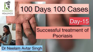 100 DAYS 100 CASES  DAY15  SUCCESSFULLY CURED PSORIASIS CASE  DR NEELAM AVTAR SINGH  Video 187 [upl. by Elleimac822]