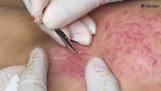 Acnes Treatment P3 [upl. by Angid77]