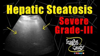 Severe Hepatic Steatosis  Severe Fatty Infiltration  Ultrasound  Case 172 [upl. by Etnahsa823]