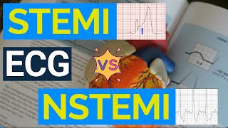 Decoding ECG Changes STEMI vs NSTEMI  A Comprehensive Guide to Heart Attack Diagnosis [upl. by Marmion498]