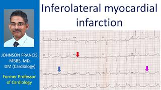 Inferolateral myocardial infarction [upl. by Hebbe]