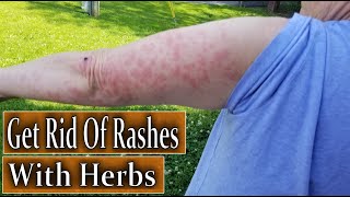 Foraging Wild Herbs To Get Rid of Rashes [upl. by Galatea]