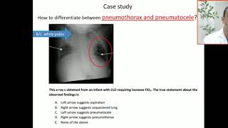 Case 41 how to differentiate between pneumothorax and pneumatocele Localized air [upl. by Oregolac632]