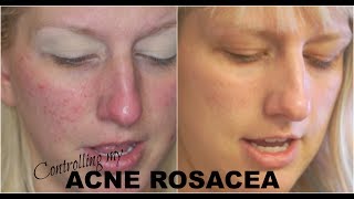 Acne Rosacea Skincare What Finally Worked Dermalogica Update 3 [upl. by Colton544]