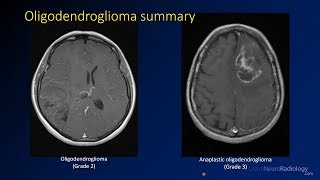 Imaging brain tumors  3  Oligodendrogliomas [upl. by Mihcaoj]