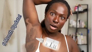 6 Months Of Using Glycolic Acid On My Armpits 😱  The Update  OHEMAA [upl. by Ced]