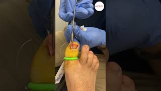 Ingrown Nail Surgery [upl. by Mari807]