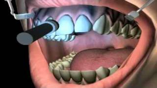 What is Teeth Bleaching [upl. by Olag]