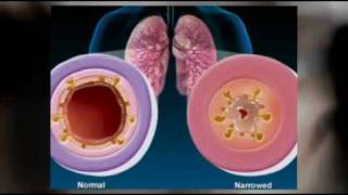 Signs and symptoms of bronchitis Natural herbs treatment of chronic bronchitis [upl. by Melania250]