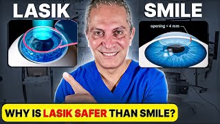 Should you Choose LASIK or SMILE Eye Surgery Eye Surgeon Explains [upl. by Bond]