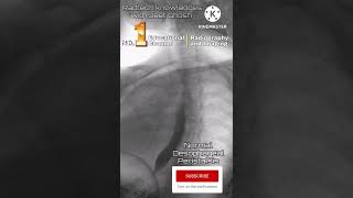 Barium swallow normal oesophagus constriction radiology xray mbbsstudent shorts [upl. by Halsted372]