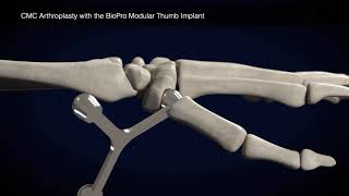 Thumb Surgery Animation with the BioPro Modular Thumb Implant [upl. by Nilerual]