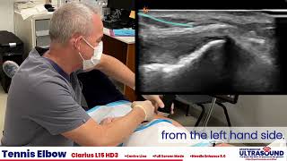 Tennis elbow injection demonstration [upl. by Friedrick]