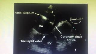 Coronary sinus ASD [upl. by Malamud]