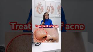 Treatment of acne and white head nose  skincare  skin therapy darkspots ​⁠DrMigraine [upl. by Aihsercal]