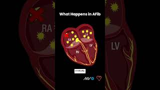 Process of AFib in Your Heart [upl. by Annadiane663]