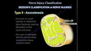 Nerve Injury types  Nerve recovery  Everything You Need To Know  Dr Nabil Ebraheim [upl. by Iroak100]