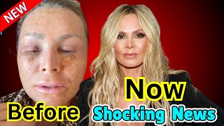 Bravo Alert Tamra Judges Mom ROASTS Her During Shocking RHOC Recovery Drama [upl. by Annabell]