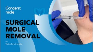 Mole Removal  Safe Surgical Procedure to Remove a Mole Skin Tag Wart  Fast Mole Surgery [upl. by Nyladnek]