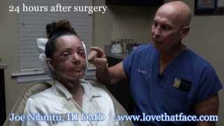 The Truth about Facelift Recovery with Multiple Procedures by Dr Joe Niamtu III [upl. by Omrelliug903]