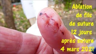 Ablation des fils de suture 12 jours après laccident de faucille 4 mars 2021 [upl. by Ekralc687]