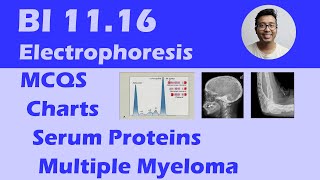 Multiple Myeloma  Analysis with Serum Protein Electrophoresis Clinical Features and MCQS BI 1116 [upl. by Assetan]