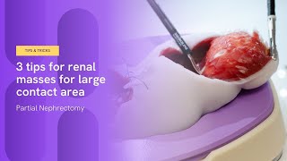 3 tips for renal masses with large contact area  Partial Nephrectomy [upl. by Yeliac378]