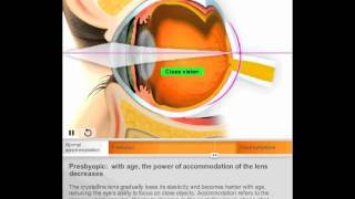 Presbyopia by Quantel Medical [upl. by Hephzibah910]