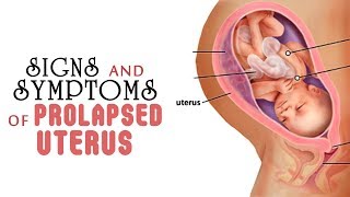 6 Signs and Symptoms of Prolapsed Uterus [upl. by Aurlie]