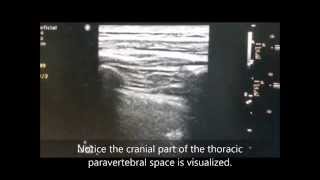 USGuided Thoracic Paravertebral Block TPVB [upl. by Lilllie]