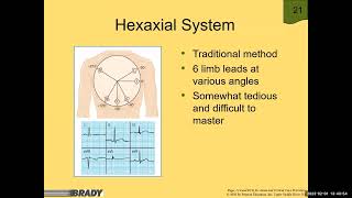 Determining Axis and Hemiblock  12 Lead ECG [upl. by Sutherland]