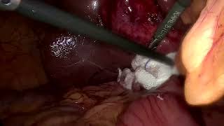 Laparoscopic cholecystectomy 24 Dure Shawar [upl. by Earahc]