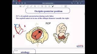 Obstetrics Fetal malpresentation 1 [upl. by Adnilra660]