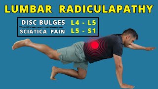 Lumbar Radiculopathy L4 L5  L5 S1 exercises for pain relief [upl. by Sybil]