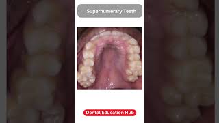 Supernumerary Teeth  Paramolar [upl. by Nyliret459]