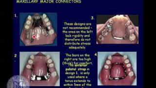 DENT 718 Classification and components of removable partial dentures [upl. by Ajnin547]