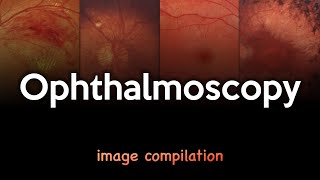 Ophthalmoscopy [upl. by February504]