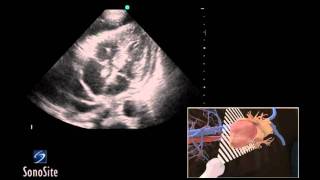 How To Ultrasound Guided Pericardiocentesis Procedure 3D Video [upl. by Winstonn]