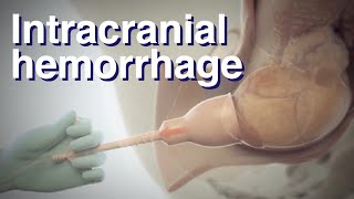 What causes an Intracranial hemorrhage birthinjury [upl. by Ardnic255]