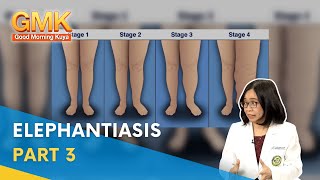 Elephantiasis Symptoms Causes and Treatment Part 3  Usapang Pangkalusugan [upl. by Macomber]