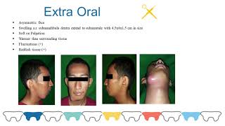 MANAGEMENT OF ABSCESS IN PATIENT WITH ODONTOGENIC INFECTIONS [upl. by Issi]