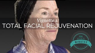 69 yo Female Total Facial Rejuvenation  An Amazing Transformation  Aesthetic Minutes Facelift [upl. by Lesoj]